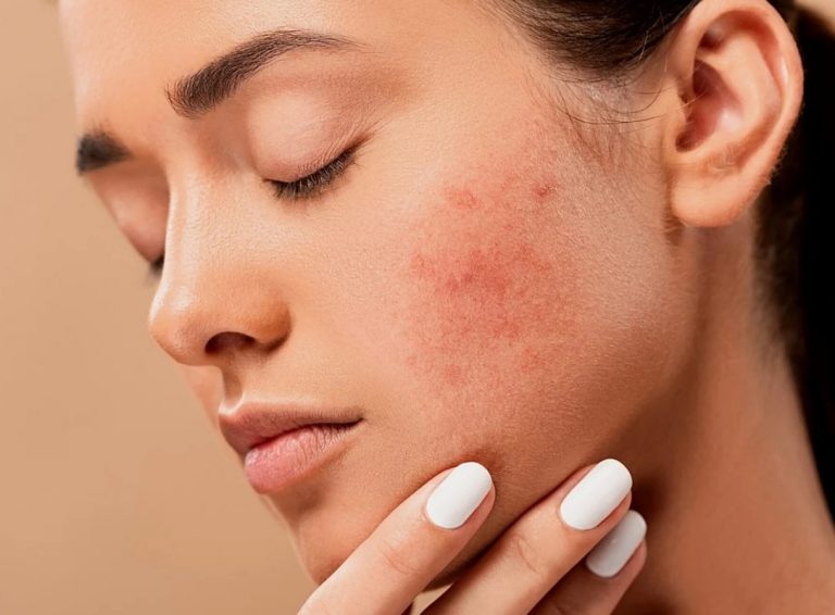 What Can You Do About Cystic Acne Scars Years Later